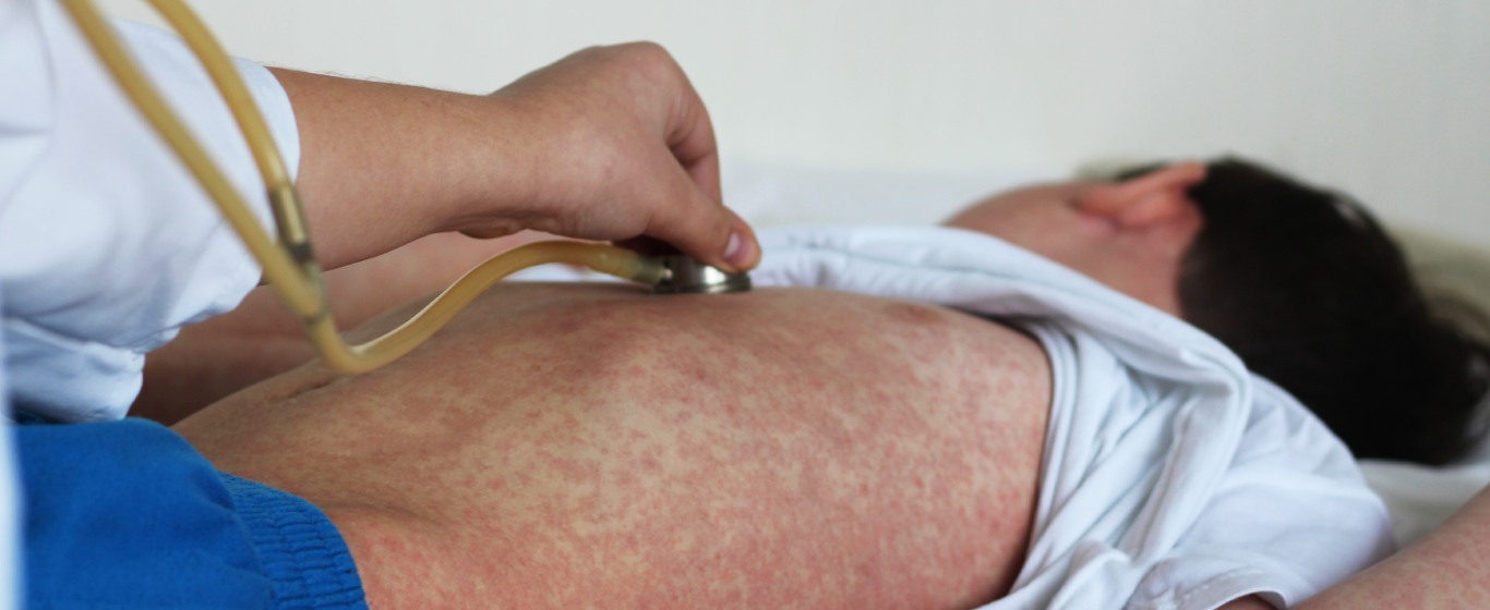 Sốt phát ban là gì? Cách nhận biết và phân biệt với sởi