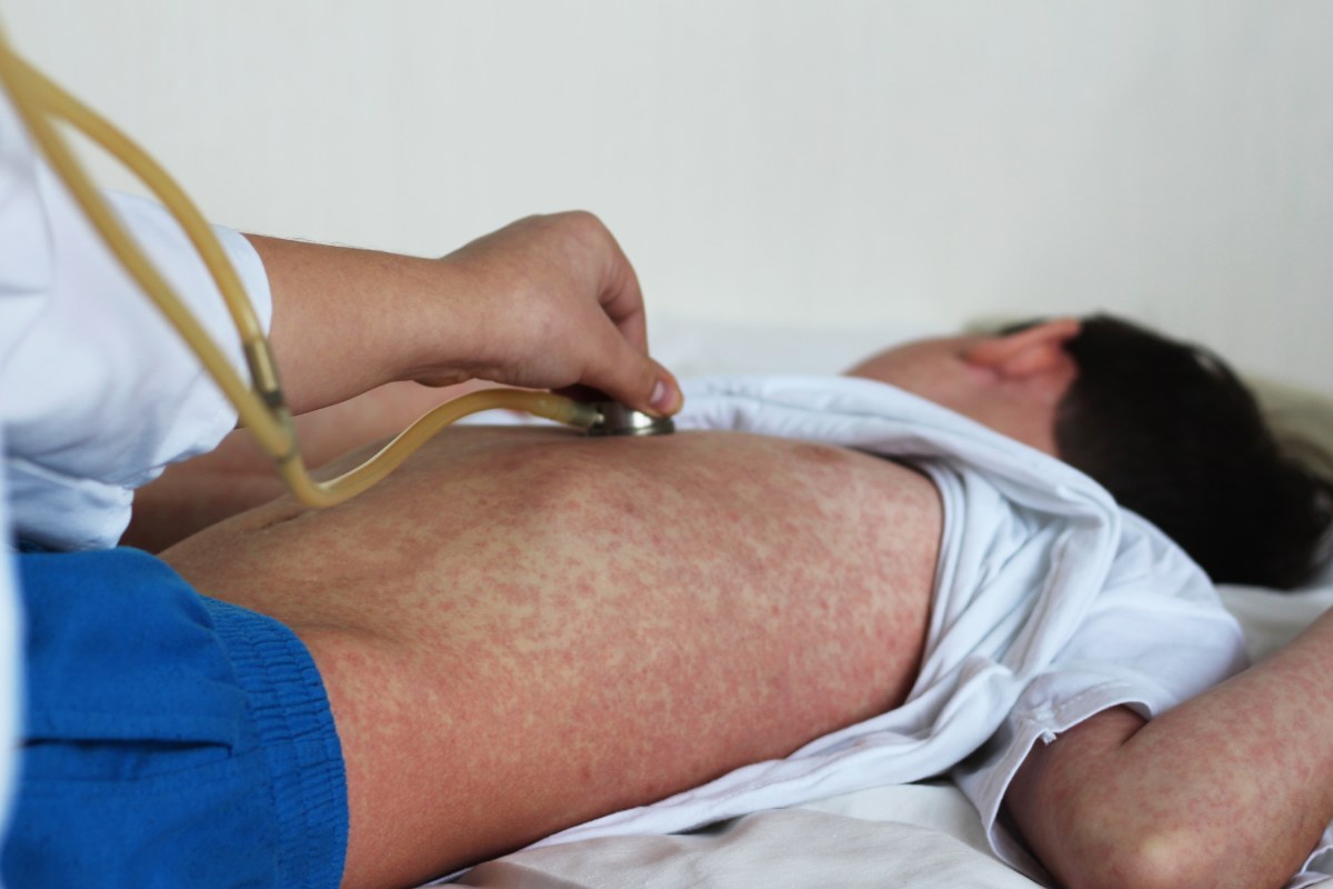 cach-phan-biet-soi-va-sot-phat-ban-de-dieu-tri-kip-thoi-1200x800-2